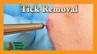 Dead Tick Removal  Auburn Medical Group [upl. by Ydnil]