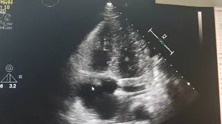 Infectious endocarditis Echocardiography [upl. by Pierpont]