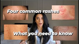 Four common rashes and everything you need to know about them [upl. by Eletnahs915]