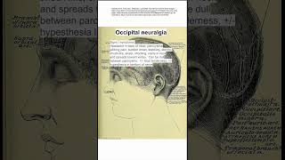 Occipital neuralgia [upl. by Yemerej]