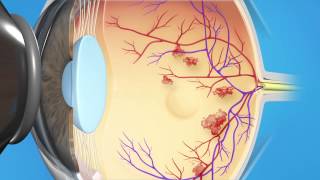 Diabetic Laser Macular Edema [upl. by Hightower715]