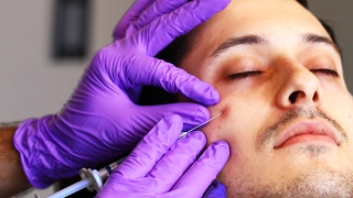 People Get Eye Bag Removal Injections [upl. by Olumor]