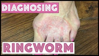 How we diagnose Ringworm Tinea Corporis [upl. by Small]