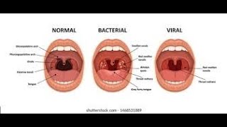 Pharyngitis Part 1 Viral Pharyngitis [upl. by Ltsyrk794]