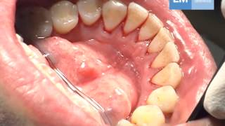 Periodontal treatment protocol [upl. by Meekah]