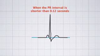 Interpreting ECG duration [upl. by Halimak]