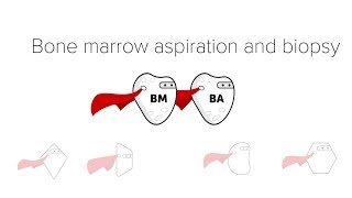 Bone Marrow Biopsy amp Aspiration BMBx [upl. by Ahsyen]