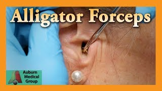 Alligator Forceps Ear Wax Removal  Auburn Medical Group [upl. by Eimareg]