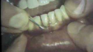 Scaling and Root Planing Part II Mandibular Teeth [upl. by Durware24]