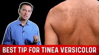 Natural Skin Fungus Tinea Versicolor Home Remedies – Dr Berg [upl. by Hartzke68]