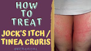 HOW TO TREAT JOCKS ITCH  TINEA CRURIS [upl. by Kroy26]