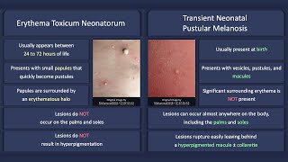 Erythema Toxicum Neonatorum vs Transient Neonatal Pustular Melanosis [upl. by Aehsel]