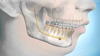 Chirurgie orthognatique ostéotomie mandibulaire [upl. by Nnor]