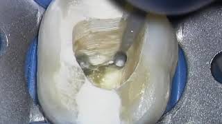 Broken Instrument Removal  Animation amp Clinical Op Sequence Advanced Endodontics [upl. by Enitsirt106]