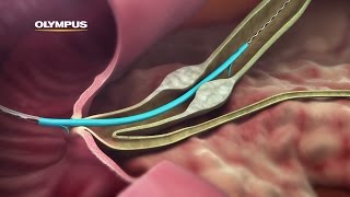 QuickPlaceV Biliary Stent [upl. by Glory474]