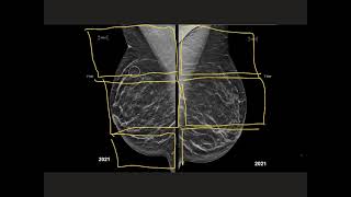 How much does a mammogram cost [upl. by Tenrag]