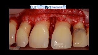 Periodontal Surgery Upper Front Teeth [upl. by Anead]