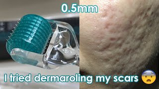 I tried dermarolling my ACNE SCARS  Demo  Review [upl. by Llerrem541]