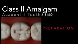 Class II Amalgam Preparation  18 MO Acadental Typodont [upl. by Nogaem]