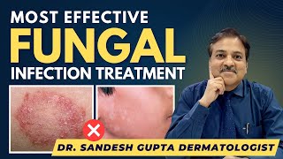 Effective Fungal Infection Treatment By Dermatologist  Dr SANDESH GUPTA 9990804089 [upl. by Airbas904]