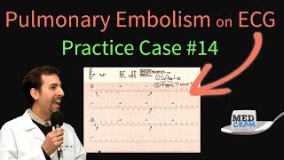 ECG Findings in Pulmonary Embolism  EKG Changes With an Acute PE [upl. by Ruberta]