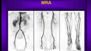 Coronary Arteries  Anatomy Tutorial [upl. by Dlabihcra]