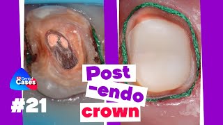 Postendo crown  BG Dental Cases 21 [upl. by Ahsiryt]