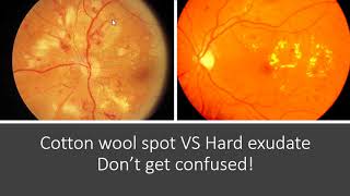 Classification of Diabetic Retinopathy [upl. by Iaverne]