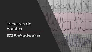 AV Nodal Reentry Tachycardia AVNRT on ECG  EKG [upl. by Hannah]