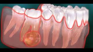 Abcès endodontique dentaire kyste [upl. by Weider875]