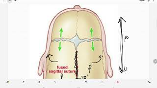 Craniosynostosis [upl. by Reinertson]