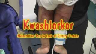 Kwashiorkor [upl. by Kung]