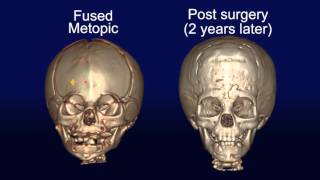 Cranial Flap Fixation [upl. by Alina]