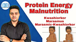 Protein Energy Malnutrition  Kwashiorkor Vs Marasmus [upl. by Mighell]