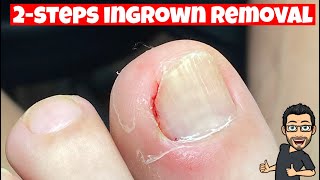 HOW TO REMOVE AN INGROWN TOENAIL [upl. by Hafeenah]