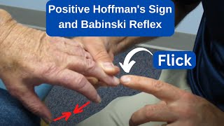 Positive Hoffmans Sign and Babinski Reflex in an MS Patient [upl. by Nosiram]