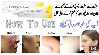 contractubex Gel  how to use contractubex [upl. by Mattah973]