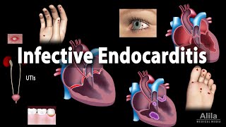 Infective Endocarditis Animation [upl. by Alliber156]