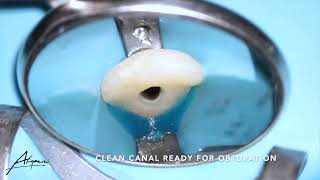 Root canal treatment on the maxillary central incisor tooth 21 [upl. by Calvano509]