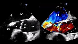 Aortic and Mitral Valve Endocarditis Due to Austin Flint Phenomenon [upl. by Atsocal]