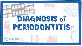 Diagnosis of Periodontitis [upl. by Carmelo]