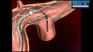 Embolização Vascular  Aneurisma Cerebral [upl. by Reilly]