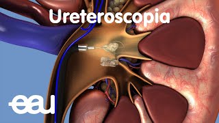 Tratamiento de cálculos renales y ureterales URS [upl. by Niuq636]