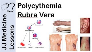 Polycythemia Rubra Vera  Pathophysiology Symptoms Diagnosis and Treatment [upl. by Scottie]