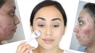 Derma Roller for Acne Scars  How I Healed My Acne Scars [upl. by Raynard]