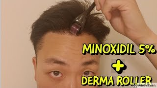 HOW TO USE DERMA ROLLER AND MINOXIDIL FOR HAIR GROWTH [upl. by Earb215]