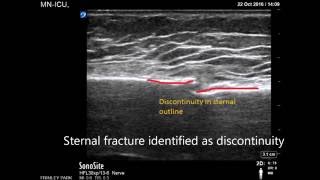 How To Treat A Fracture amp Fracture Types  First Aid Training  St John Ambulance [upl. by Verine525]