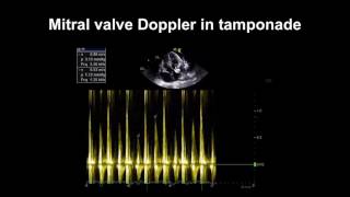 Echocardiography Essentials Detecting pericardial effusions [upl. by Dworman]