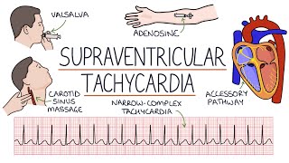 Understanding Supraventricular Tachycardia SVT [upl. by Wavell794]