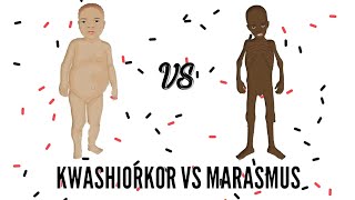 SAM  Severe Acute Malnutrition  Kwashiorkor VS Marasmus [upl. by Ellekram985]